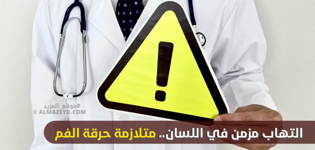 التهاب مزمن في اللسان.. متلازمة حرقة الفم