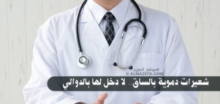 شعيرات دموية بالساق.. لا دخل لها بالدوالي